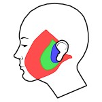 Facelift_incisions_and_undermining_of_different_procedures